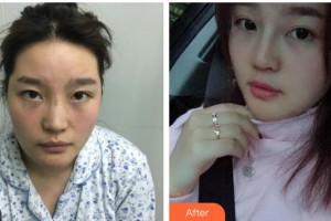 遂寧市中心醫(yī)院燒傷整形科王國昌整形價格表附鼻部手術案例展示