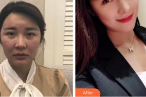 樂山金手指醫(yī)學(xué)美容診所方名整形價(jià)格表附肋軟骨隆鼻案例展示