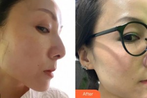 樂山金手指醫(yī)學(xué)美容診所羅秀平整形價(jià)格表附埋線提升案例展示