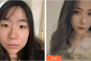 樂山天姿醫(yī)療美容診所楊劍軍整形價(jià)格表附埋線雙眼皮案例展示