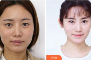 樂山市人民醫(yī)院燒傷整形外科賴運(yùn)泰整形價(jià)格表附眼部綜合案例展示