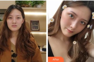 樂山美銳整形美容診所魏海軍整形價(jià)格表附切開雙眼皮案例展示