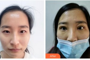 樂山美銳整形美容診所謝斌冰整形價(jià)格表附眼部綜合案例展示