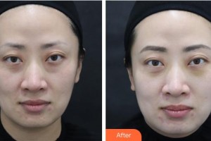 樂山王玉琨皮膚病?？漆t(yī)院王玉琨整形價(jià)格表附激光去眼袋案例展示