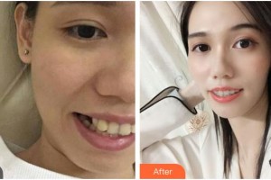樂山英美口腔診所孫玉萍整形價(jià)格表附金屬托槽矯正案例展示