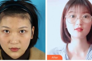 樂山愛爾眼科醫(yī)院張繼萍整形價格表附內切祛眼袋案例展示