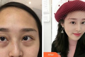 南充醫(yī)美整形外科診所袁學江整形價格表附內切祛眼袋案例展示