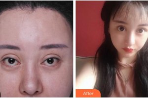 南充嬌美傾城醫(yī)學美容門診部劉娟整形價格表附眼部修復案例展示