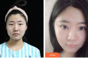 南充圣仁安名仁眼科醫(yī)院廖瓊整形價(jià)格表附切開雙眼皮案例展示
