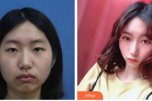 南充潤禾皮膚病?？漆t(yī)院萬年整形價(jià)格表附上瞼提肌案例展示