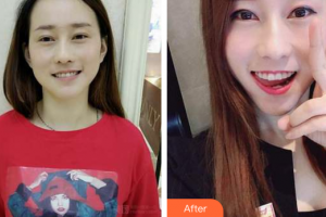深圳南州口腔門(mén)診部李王勝整形價(jià)格表附牙齒隱形矯正案例展示