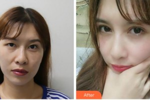 眉山眼耳鼻咽喉?？漆t(yī)院龔恩進(jìn)整形價(jià)格表附切開雙眼皮案例展示