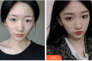 廣安華美悅美整形美容醫(yī)院蔣朝華整形價(jià)格表附切開(kāi)雙眼皮案例展示