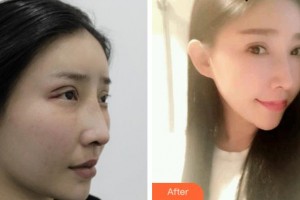 達(dá)州市中西醫(yī)結(jié)合醫(yī)院眼科鄒德整形價(jià)格表附切開(kāi)雙眼皮案例展示