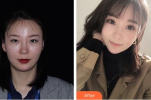 涼山愛爾眼科醫(yī)院葉先鋒整形價格表附眼部綜合案例展示