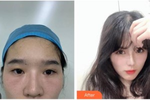 涼山愛爾眼科醫(yī)院黃應(yīng)祥整形價格表附眼部修復案例展示
