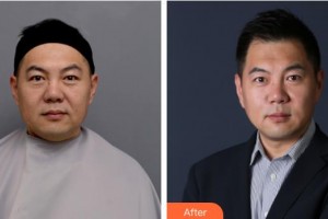 湖南省人民醫(yī)院整形激光美容中心朱軼整形價(jià)格表附埋線(xiàn)提升案例展示