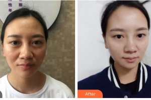 湖南省南華大學(xué)附一醫(yī)院激光美容中心譚善彰 整形價(jià)格表附埋線(xiàn)提升案例展示