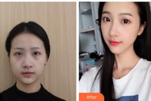 湖南中醫(yī)藥大學(xué)第一附屬醫(yī)院整形美容中心楊文彪整形價(jià)格表附埋線(xiàn)提升案例展示