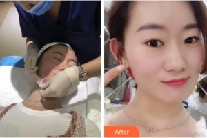 湖南中醫(yī)藥大學(xué)第一附屬醫(yī)院整形美容中心劉芳整形價(jià)格表附埋線(xiàn)提升案例展示