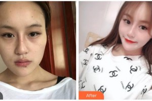湖南省人民醫(yī)院整形激光美容中心丁衛(wèi)住院醫(yī)師整形價(jià)格表附埋線(xiàn)提升案例展示