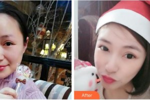 湖南省第二人民醫(yī)院整形美容中心肖調(diào)立整形價(jià)格表附埋線(xiàn)提升案例展示