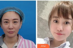 湖南省第二人民醫(yī)院整形美容中心宋金榮整形價(jià)格表附埋線(xiàn)提升案例展示