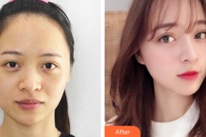 中國科學(xué)院大學(xué)深圳醫(yī)院醫(yī)療美容科梁大寧整形價(jià)格表附超激光美膚激光祛斑案例展示
