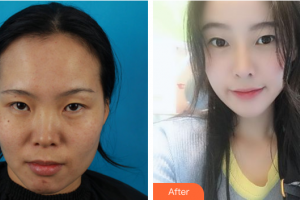 佛山凱潤婷整形美容醫(yī)院卞鵬飛整形價(jià)格表附自體脂肪填充案例展示