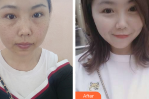 江門?？滇t(yī)學(xué)整形美容醫(yī)院李嘉欣整形價(jià)格表附祛雀斑案例展示