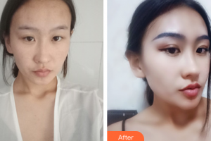 江門?？滇t(yī)學(xué)整形美容醫(yī)院付洪波整形價(jià)格表附眼部手術(shù)案例展示