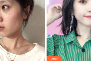 江門?？滇t(yī)學(xué)整形美容醫(yī)院蔡劍芳整形價(jià)格表附激光美膚激光祛斑案例展示