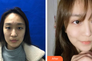 湛江華美整形美容醫(yī)院樊濤整形價格表附美眼案例展示
