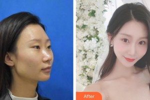 河南省人民醫(yī)院整形美容中心侴海燕整形價(jià)格表附鼻部手術(shù)案例展示