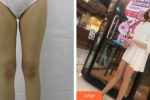 河南整形美容醫(yī)院宣旭整形價(jià)格表附大腿吸脂案例展示