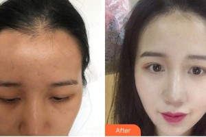 河南省整形美容研究中心馬中望整形價(jià)格表附植發(fā)案例展示