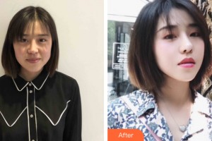 河南省整形美容研究中心王麗娟整形價(jià)格表附皮膚美容案例展示