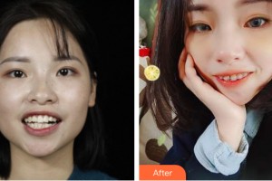 海南泰康拜博口腔醫(yī)院顏福壯整形價格表附牙齒矯正案例展示