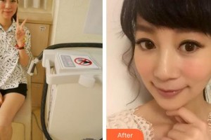 云南華美美萊美容醫(yī)院Lemperle(藍博)整形價格表附鐳射凈膚案例展示