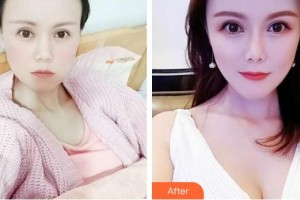 武警云南省邊防總隊醫(yī)院整形美容中心王強整形價格表附假體隆胸案例展示