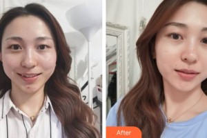 海南省農墾總局醫(yī)院頭頸頜面整形外科劉偉松整形價格表附皮膚美容案例展示
