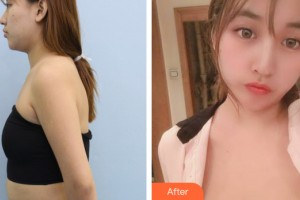 海南菲思卡爾醫(yī)學美容門診部陳政軍整形價格表附隆胸手術案例展示
