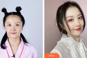 海南美媛醫(yī)學(xué)美容門診部杜洛鋒整形價格表附植發(fā)案例展示