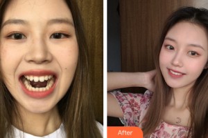 海南美媛醫(yī)學(xué)美容門診部約翰奇整形價格表附牙齒種植案例展示