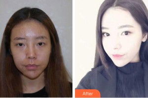 南寧夢想DREAM整形醫(yī)院萬偉東整形價(jià)格表附鼻部手術(shù)案例展示