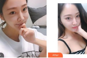 整形醫(yī)院王強整形價格表附光子嫩膚案例展示