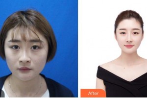 昆明吳氏嘉美美容醫(yī)院朱妮娜整形價格表附鼻修復案例展示
