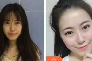昆明都市儷人美容醫(yī)院李韻整形價格表附去痘印痘坑案例展示