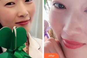 昆明韓辰整形醫(yī)院李相奇整形價(jià)格表附切開雙眼皮案例展示