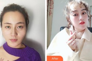 昆明美立方（原大華）醫(yī)療美容醫(yī)院段瑞平整形價格表附顴骨顴弓整形術案例展示